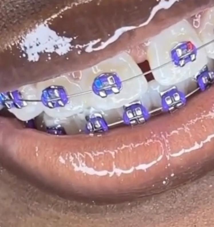 Removable Purple Braces - Unique style